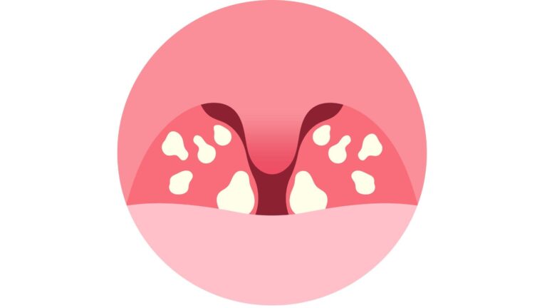急性扁桃炎 - 瑞穂区の名古屋はなまる耳鼻科クリニック|日曜日も診療してる耳鼻咽喉科
